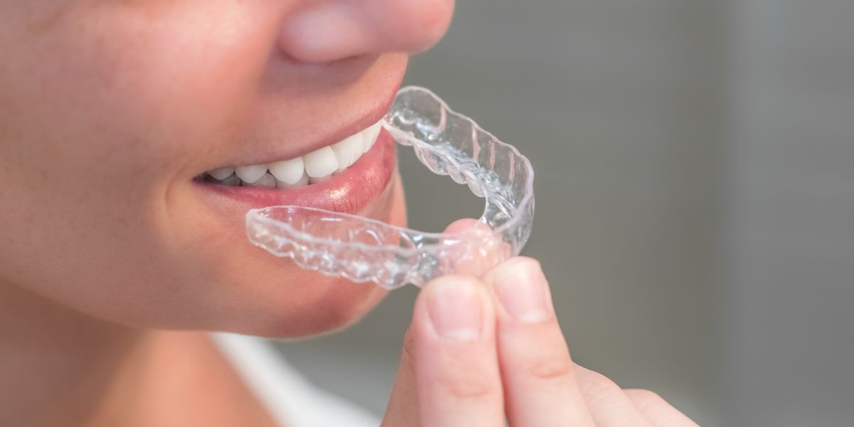 Inexpensive Braces For Adults Inexpensive braces for adults